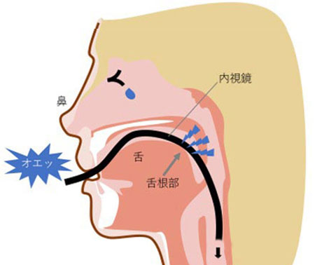口からの場合